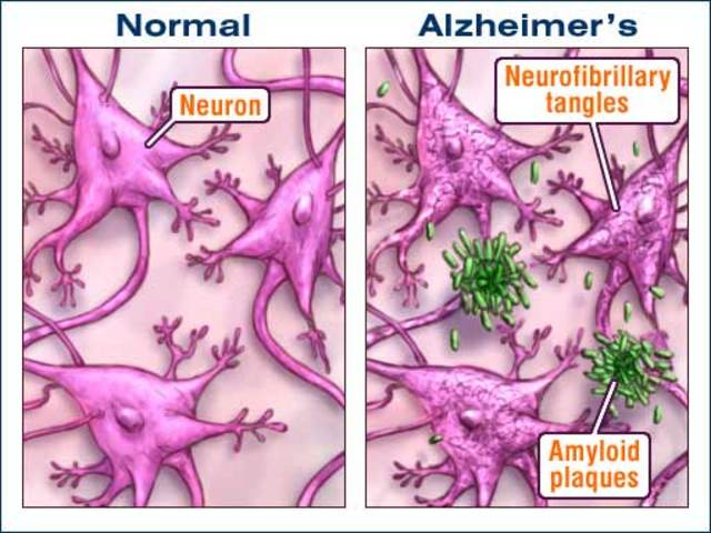 El cobre dispara y potencia la enfermedad de alzheimer