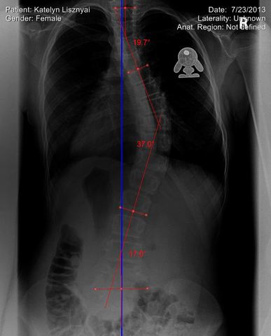 Diagnosed with Scoliosis