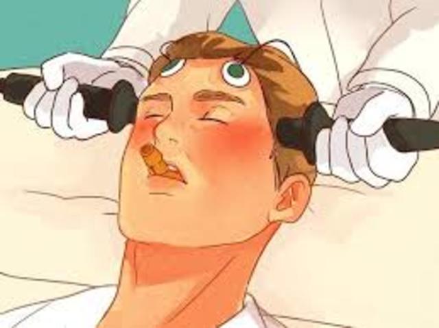 Terapia Electroconvulsiva