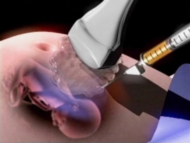 diagnostico prenatal