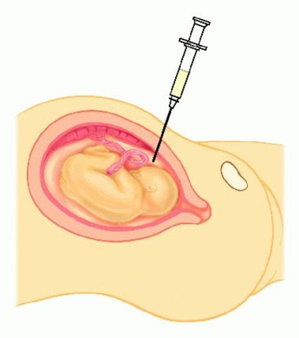 se realiza el primer diagnóstico prenatal de una enfermedad humana por medio del análisis del ADN.