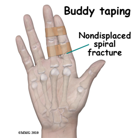 Broke my middle finger