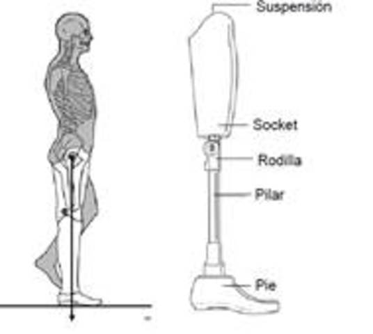 Primera prótesis por debajo de la rodilla