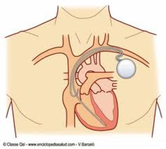 Primer marcapasos artificial