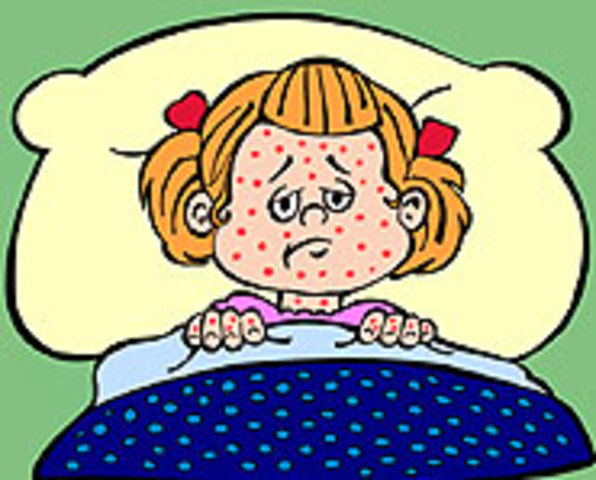 Chicken Pox