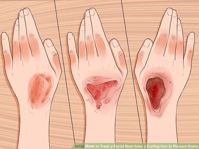 when i burned my hand with the hot water of cup of noodles.