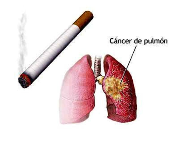 El cáncer pulmonar y el hábito de fumar como un modelo de la caja negra
