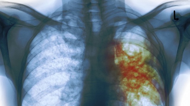 Vacuna contra la tuberculosis