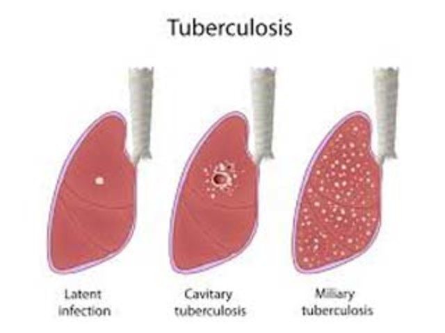 Vacuna contra la tuberculosis