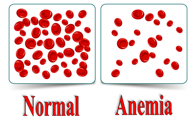 Anemia
