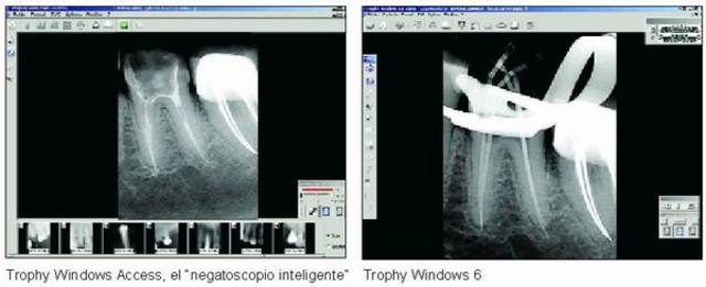 RadioVisiografía (Trophy Radiology).