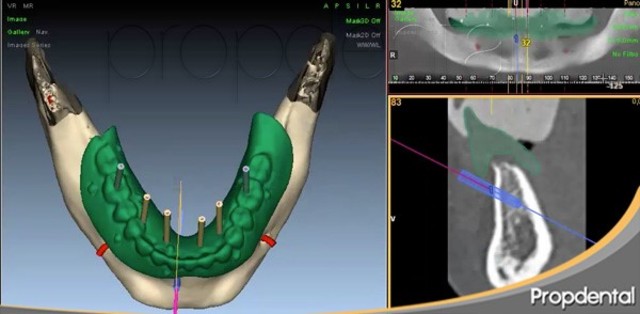 Ccirugía e implantología guiadas