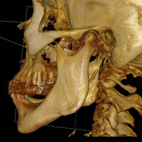 Mandibula 3D
