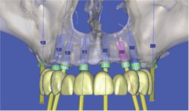 herramientas muy especializadas para la planificación en cirugía e implantología.