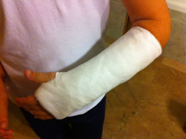 I broke my arm