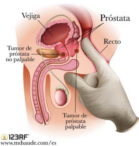 "Cáncer de próstata"