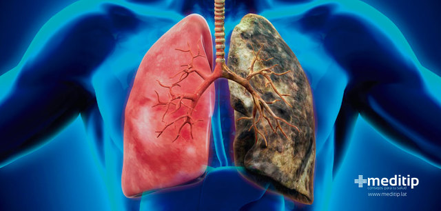 "Cáncer de pulmón"