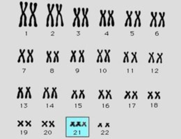 "Anomalías cromosomícas - Sindrome de Down"