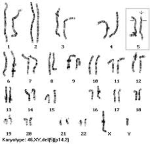 Síndrome de Cri du Chat