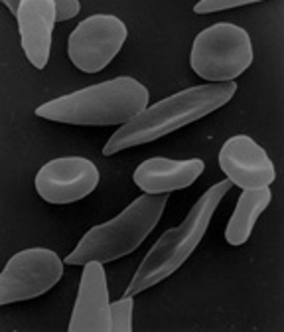 Anemia Falciforme