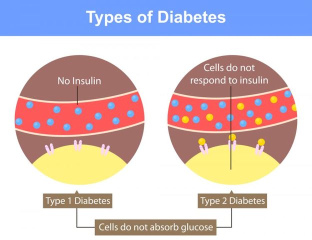 Distinction Between Two Types of Diabetes