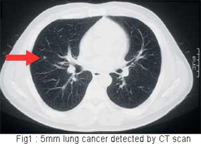 CT Scan for Lung Cancer