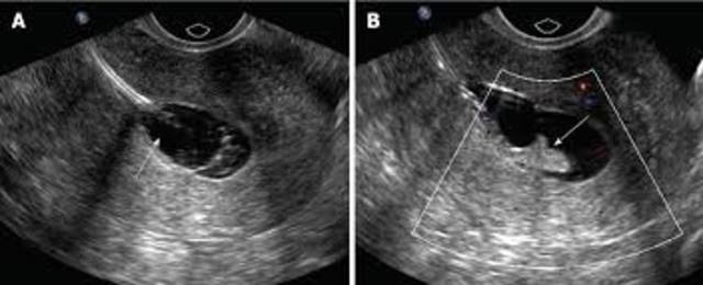Ultrasound for Endometrial Cancer