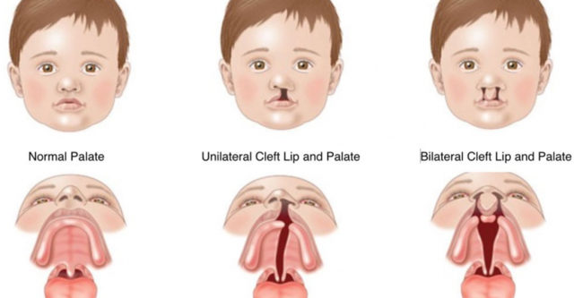Cleft Lip or Palate may occur