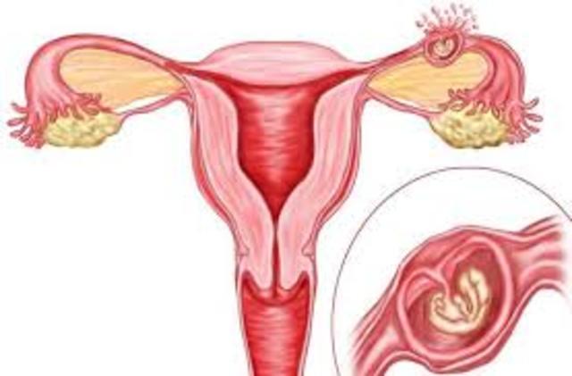 Ectopic Pregnancy Could Occur