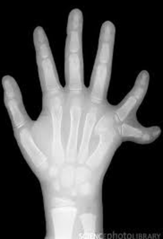 Mutation of Genetics in X-rays