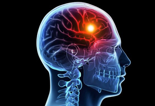 Ingreso a Urgencias, presenta ECV