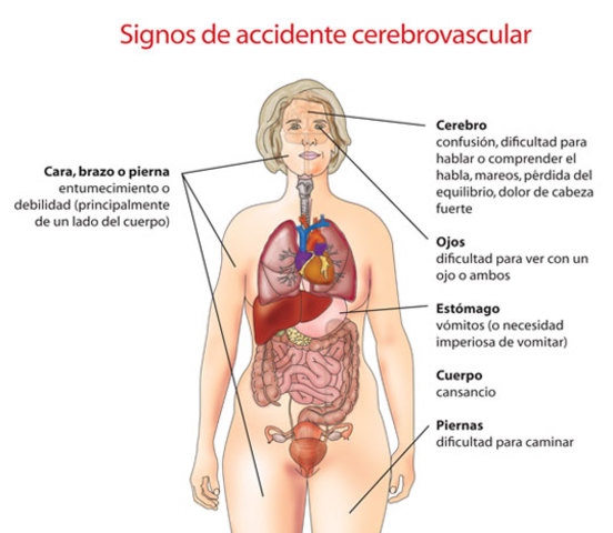 Paciente con secuelas de ACV