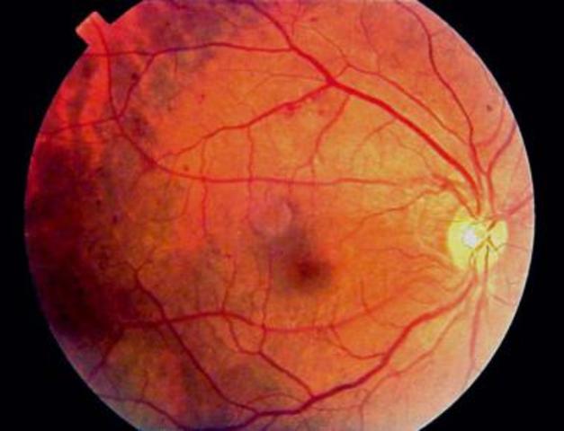 Laser Therapy for Retinopathy Introduced