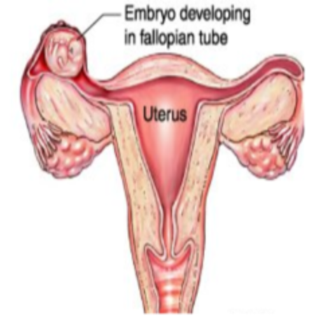 ectopic pregnancy could occur