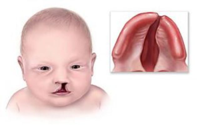 cleft lip or palate may occur