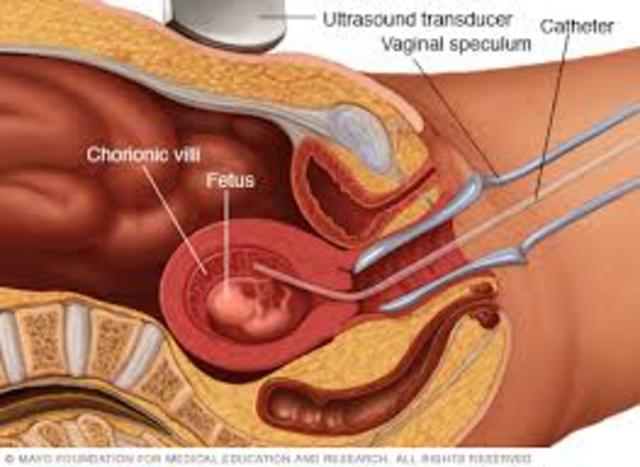Chorionic Villi Sampling Could be Performed