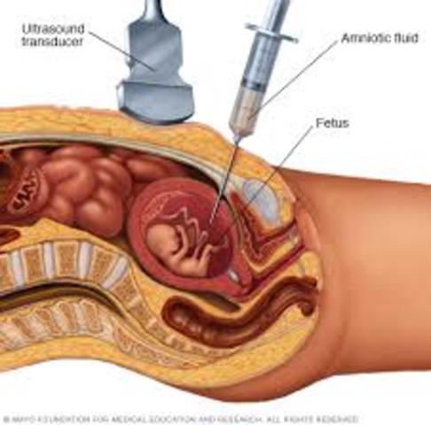 Amniocentesis Could be Performed