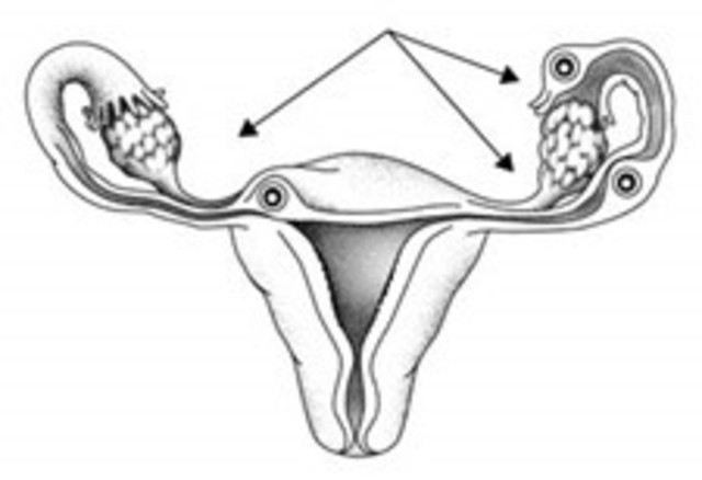 Ectopic pregnancy could occur
