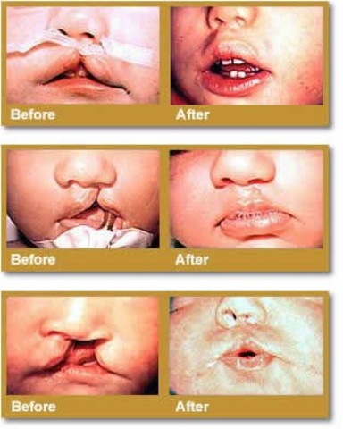 cleft lip or palate may occur