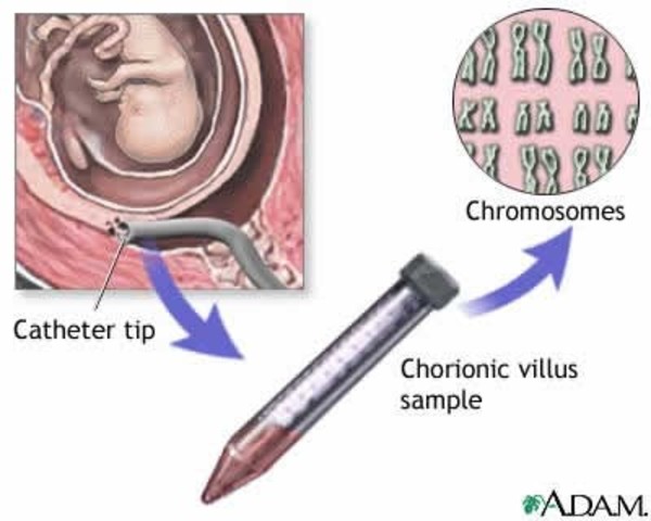chorionic villi sampling can be performed
