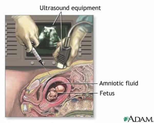 amniocentesis can be performed