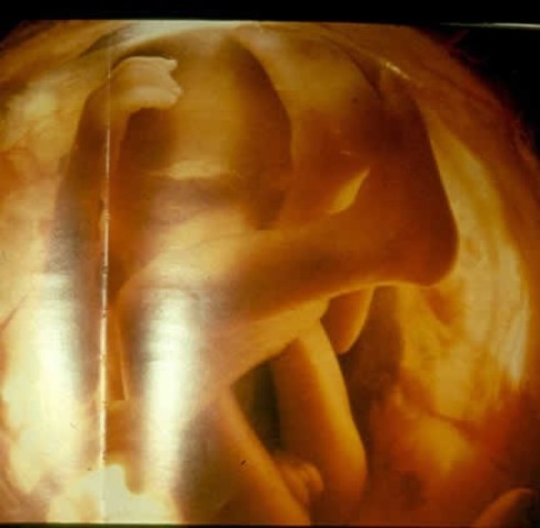 eyes open, fat added under skin