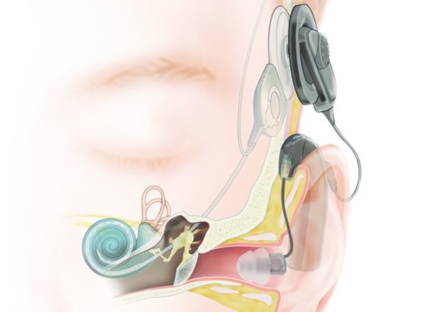 Cochlear Implant
