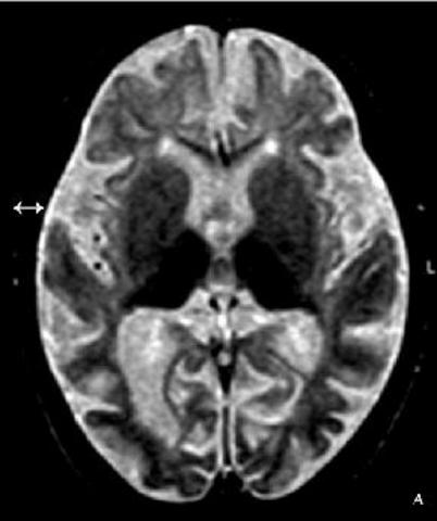 By 12 Months Intelectually