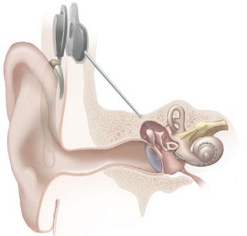 Cochlear Implant