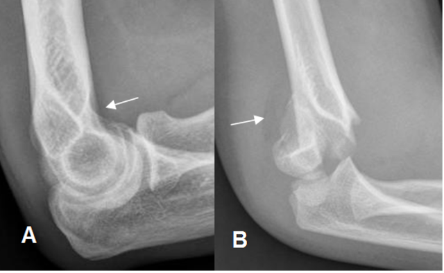 me fracture en brazo