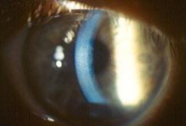 Gabe newell suffered from Fuchs' dystrophy