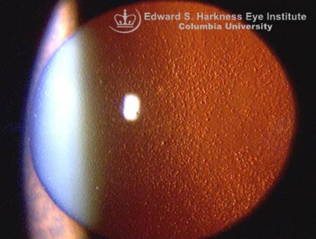 Gabe newell suffered from Fuchs' dystrophy again.