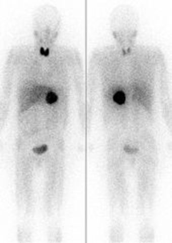 Hamilton Estudios con I131