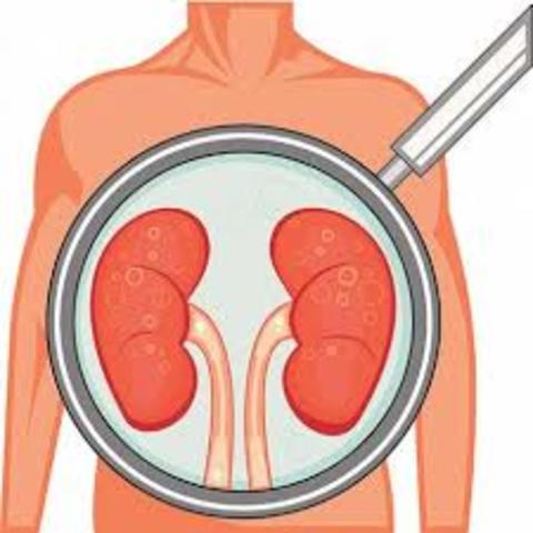Anuncio de la enfermedad hematuria